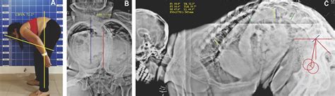 Two Level Pedicle Subtraction Osteotomy In Lateral Position