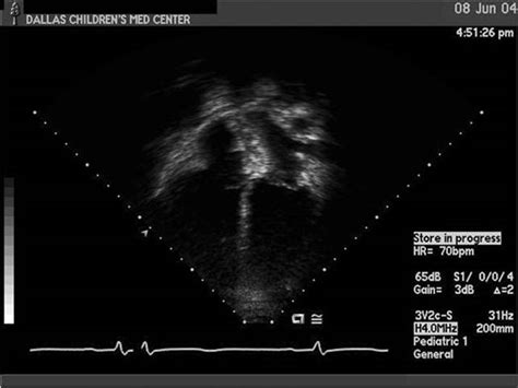 Atrial Septal Defect Transthoracic Echocardiography Wikidoc