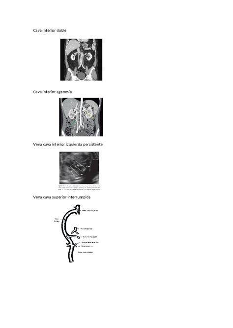 malformaciones cavas Anatomía Ii Cava inferior doble Cava inferior