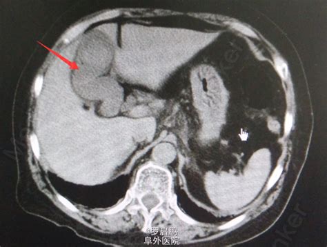 胆囊结石并发急性胰腺炎一例 医联