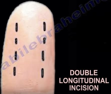 Felon - Bacteria Infections Orthopedics finger Healthcare