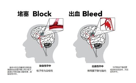 急救科普 脑卒中识别与急救处置：b E F A S T 知乎