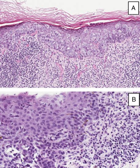 A Vulvar Paget Disease Clusters Of Large Pale Paget Cells With Download Scientific Diagram