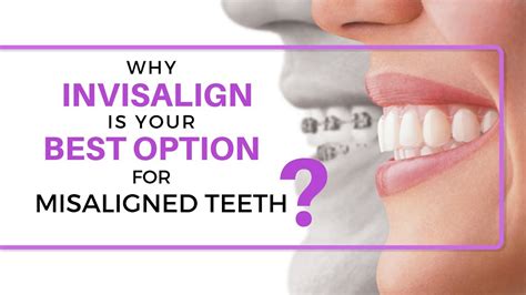 Why Invisalign Is Your Best Option To Address Misaligned Teeth Youtube