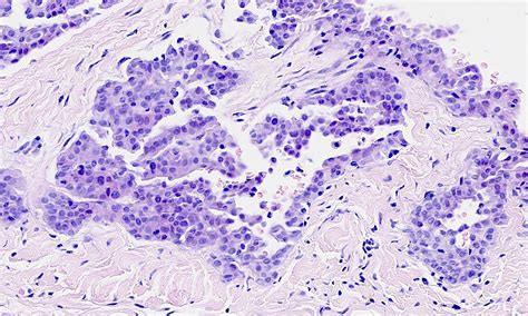 Sarcomatoid Mesothelioma Pathology Outlines - Gabyy Moraa