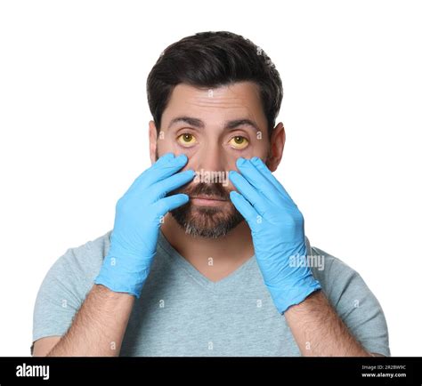 Man checking his health condition on white background. Yellow eyes as ...