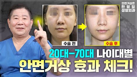 나이대별 안면거상 효과 20대부터 70대 까지 수술 결과 확인 Youtube