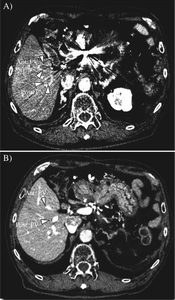 Abdominal Contrast Enhanced Computed Tomography Before And After