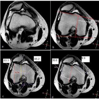 a, b MRI images for grade IV chondromalacia patella with infrapatellar ...