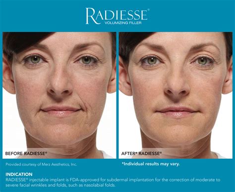 Radiesse Before And After Photos Dermatology Boca Raton Dermatologist