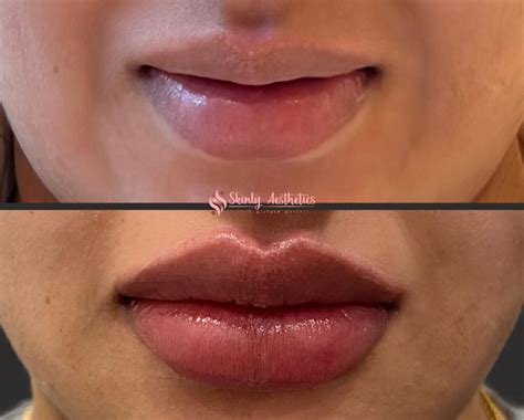 Russian Lip Filler By Md 800 Book Now