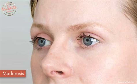 Hypothyroidism Eyebrows