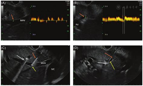 Endoscopic Ultrasound Guided Portal Pressure Gradient Identifies