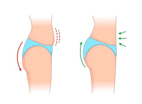 What Is A Brazilian Butt Lift Procedure Costs Raadina Health