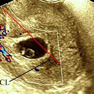 Ultrasound A B C Images Showing Differentiation Of Cesarean Scar