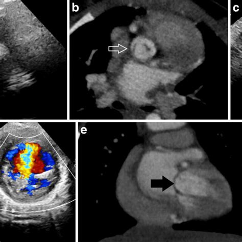 Echocardiography And Cardiac Computed Tomography Angiography Ccta In