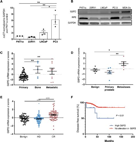 G6pd Is Overexpressed In Bone Metastatic Prostate Cancer A Mrna