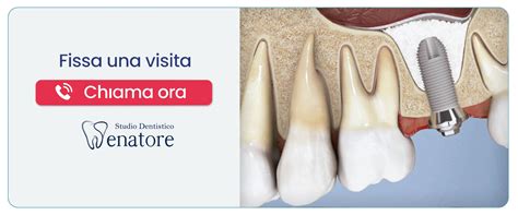 Rialzo Seno Mascellare Studio Dentistico Senatore