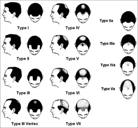 雄性脱发的等级划分 知乎