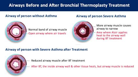 Bronchial Thermoplasty for Asthma | MedStar Health