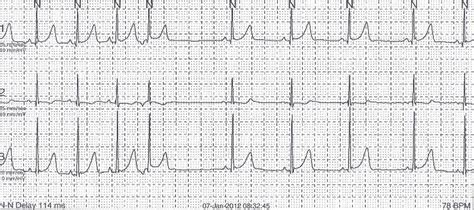 Pedi cardiology: Atrial ectopy