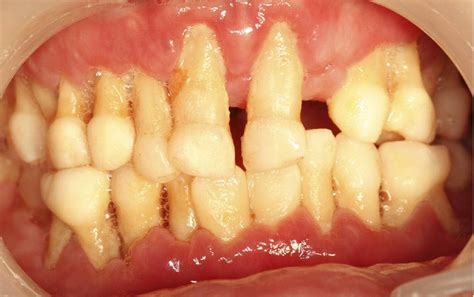 Pediatric Wegeners Granulomatosis With Oral Ulcers And Progressive