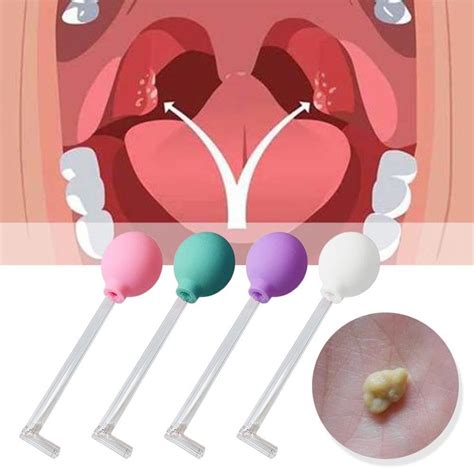 Amazon Tonsil Stone Remover Manual Vacuum Tonsil Stone Removal