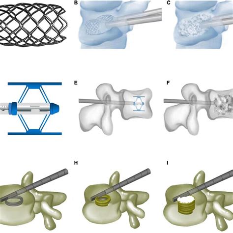 Vertebral body stenting, Spine Jack, and Kiva system. (A) Vertebral ...