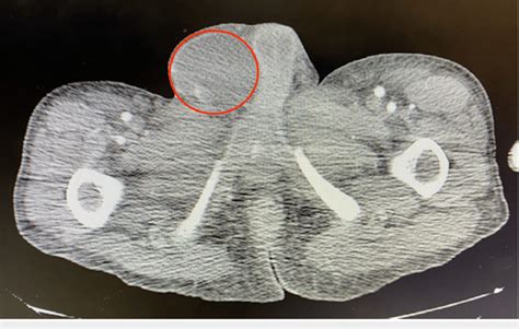 CT Scan Showing Large Right Testicular Mass Red Circle CT Computed