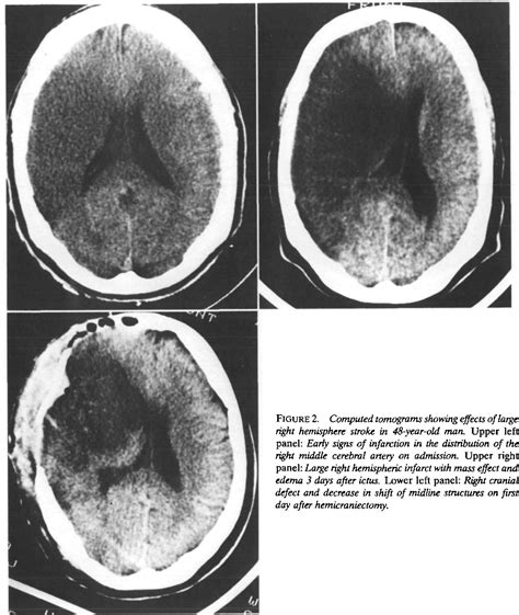 Figure 1 From Treatment Of Right Hemispheric Cerebral Infarction By Hemicraniectomy Semantic