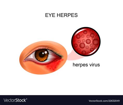 Albums 99 Pictures Herpes In Your Eye Pictures Excellent