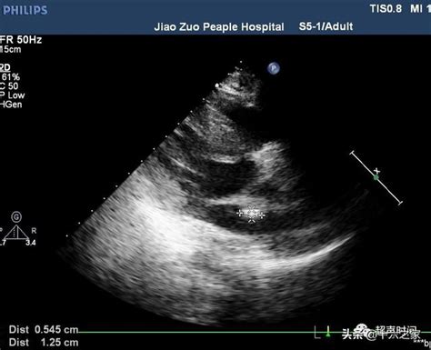 超聲典型病例心臟金屬異物 每日頭條