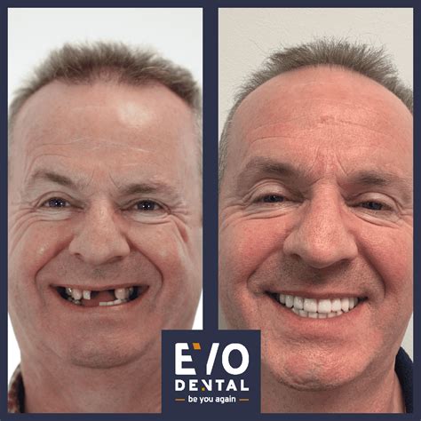 Dental Implants Dartford Free Consultation In Dartford