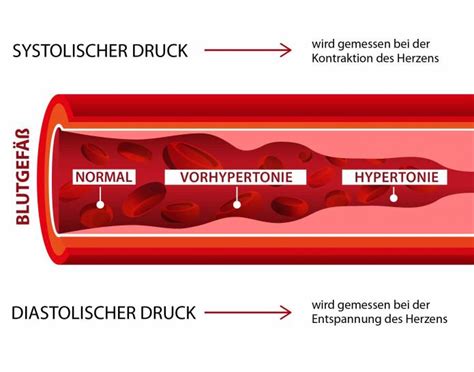 Bluthochdruck