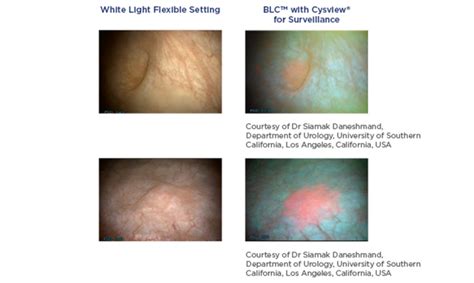 Blue Light Cystoscopy Procedure Shelly Lighting