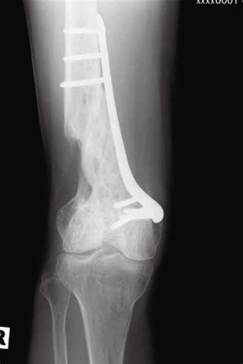 Radiograph Of The Knee At Year Follow Up Anteroposterior A And