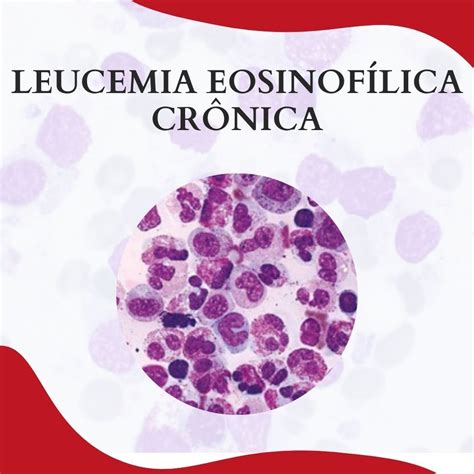 Leucemia EosinofÍlica CrÔnica Atlas Em Hematologia