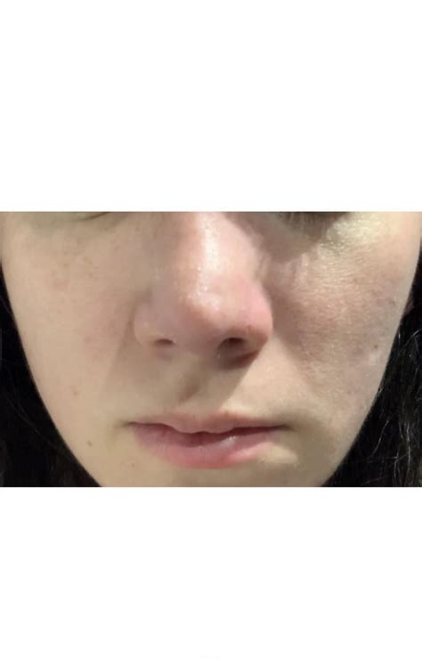 Got A Rhinoplasty 5 Weeks Ago And Recently Noticed A Hole Everytime I