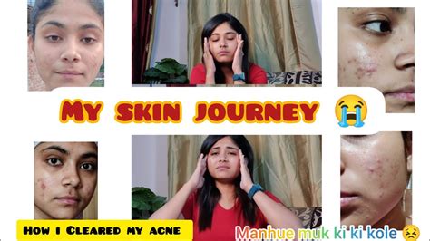 How I Cleared My Acne My Skin Journey 🙂 Youtube