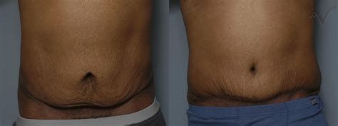 Tummy Tuck Before And After Weight Loss