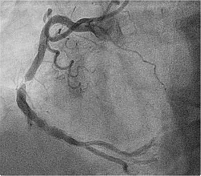 Frontiers Intravascular Imaging In Coronary Stent Restenosis