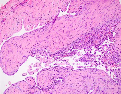 Inflammatory Papillary Hyperplasia Histology