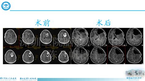 【会议报道】中山大学肿瘤防治中心－深圳二院疑难胶质瘤多学科诊疗（mdt）2022年8月期 健康160