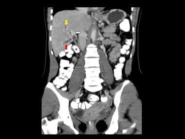 Portal Vein Thrombosis Imaging Practice Essentials Radiography