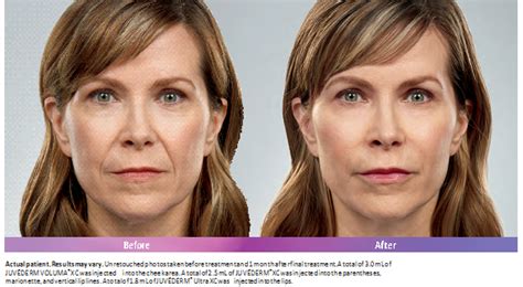 Fillers Dermatologist In Santa Monica Ca