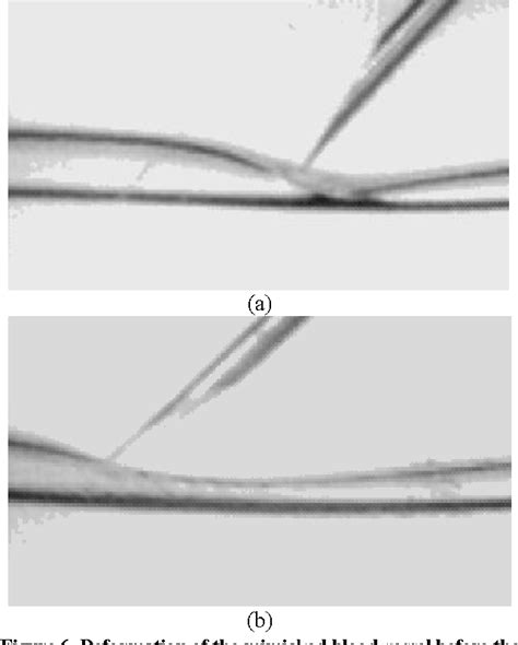 Figure 6 from Investigation of Needle Bevel Face Up and Down ...