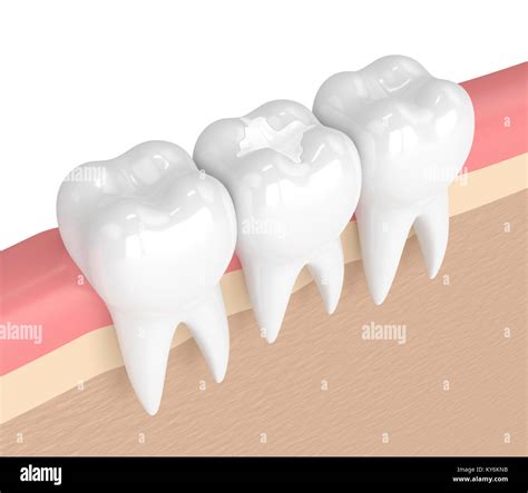 D Render Of Teeth With Dental Composite Filling In Gums Stock Photo