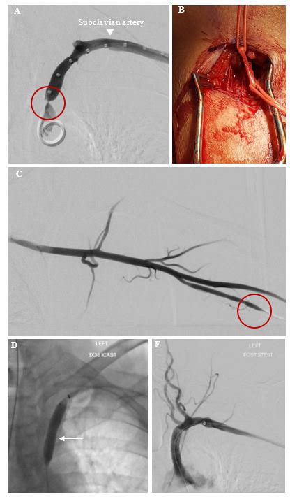 A Pre Procedure Arteriogram Of The Left Subclavian Artery The Download Scientific Diagram