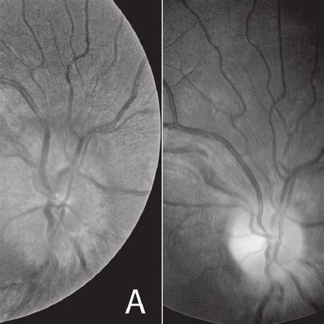 Fundus photograph of the right eye (A) reveals marked optic nerve head... | Download Scientific ...