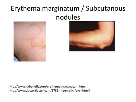 Rheumatic Heart Disease Acute Rheumatic Fever